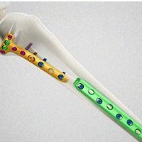 Placas para Grandes Fragmentos