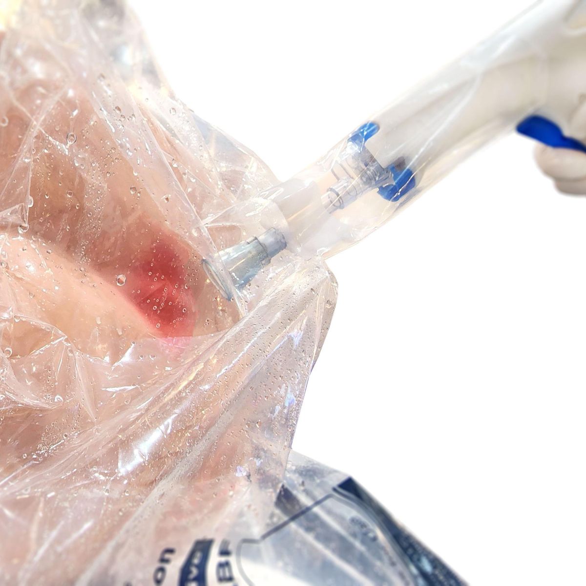 ComfortHeal™ Contained Wound Irrigation System