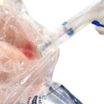 ComfortHeal™ Contained Wound Irrigation System