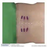 Denique , MIS, Pediatric Pedicle Screw Systems