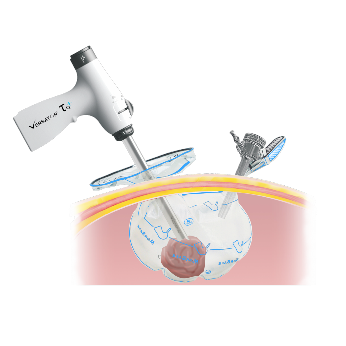 #MorSafe® – Tissue Morcellation Bag