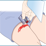 iTClamp - Dispositivo de controle de hemorragia