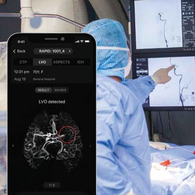 Inteligência Artificial para AVC | RapidAI