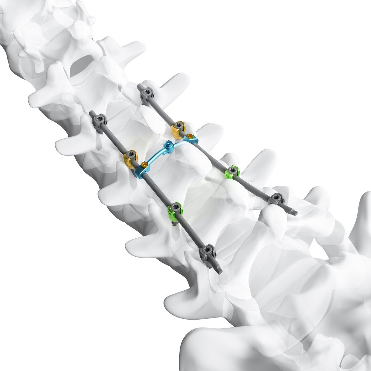 Spine Rod Position Thoracic and lumbar posterior spine screw-rod system