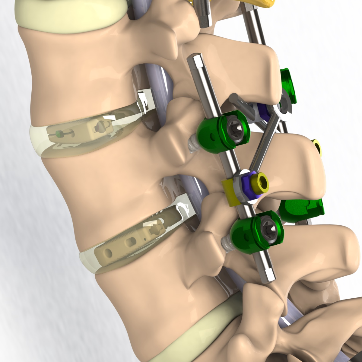 ALECTA Posterior Lumbar Interbody Fusion Cages PLIF TLIF ALIF alecta-posterior-lumbar-interbody-fusion-cages-plif-tlif-alif