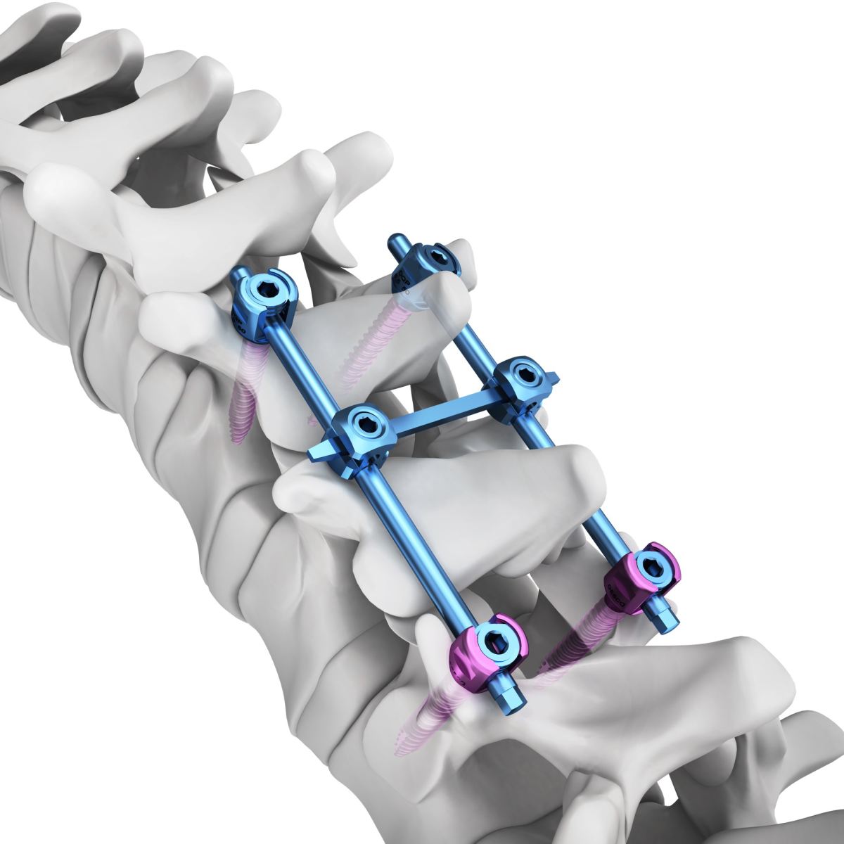 Spinal Implant systems